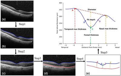 Prediction of postoperative visual acuity in patients with age-related cataracts using macular optical coherence tomography-based deep learning method